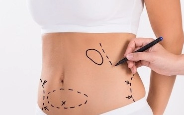 liposuction